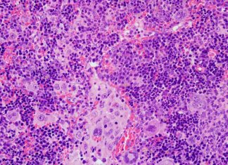Imagen de microscopía del bazo de un ratón que ha desarrollado un linfoma periférico de células T a causa de alteraciones en el gen VAV1. - USAL