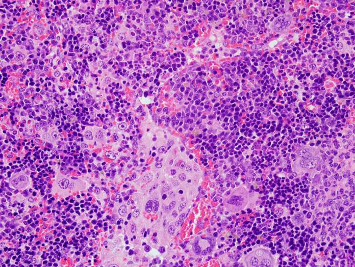 Imagen de microscopía del bazo de un ratón que ha desarrollado un linfoma periférico de células T a causa de alteraciones en el gen VAV1. - USAL