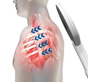 Ilustración de estimulación magnética en el cuerpo humano