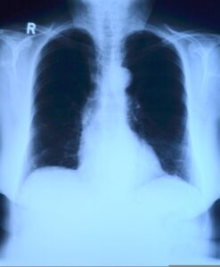 Radiografía de tórax mostrando pulmones y estructuras torácicas