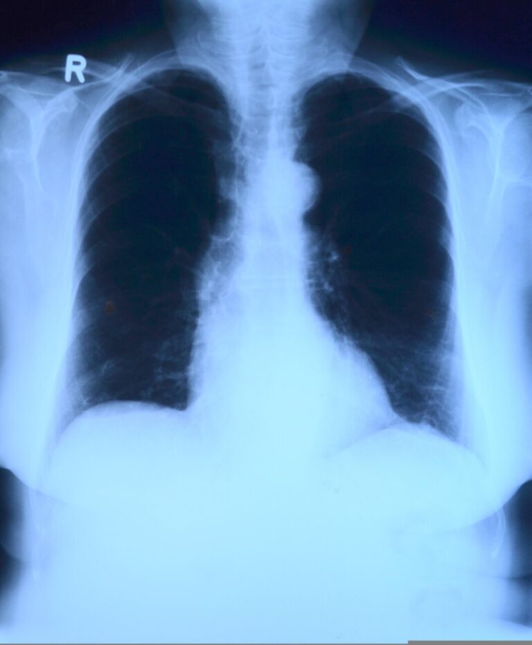 Radiografía de tórax mostrando pulmones y estructuras torácicas